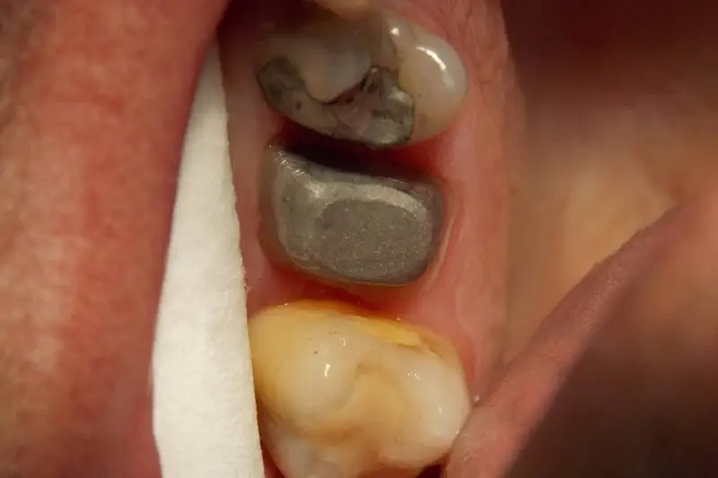 Zubní korunka